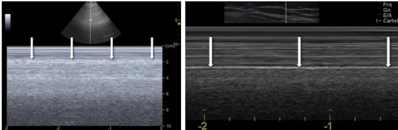 Figure 6. Pouls pulmonaire 