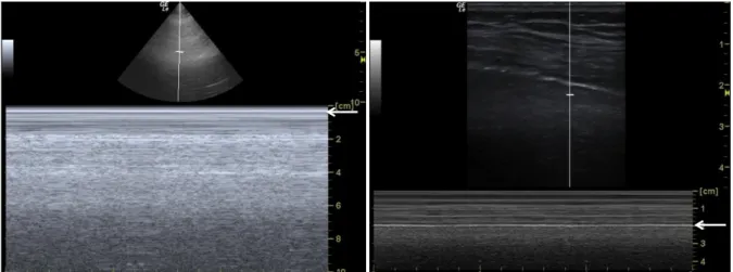 Figure 2 : Image TM pleuro pulmonaire normale. 