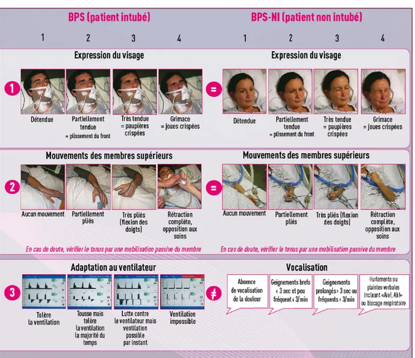 Figure 2.- Behavioral Pain Scale (BPS) de 3 à 12, d’après [19], modifiée pour le patient non intubé (BPS-NI) d’après [21] 
