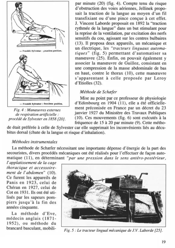 Fig. 4 : Manœuvres externes  de respiration artificielle :  procédé de Sylvester en 1858 [20]