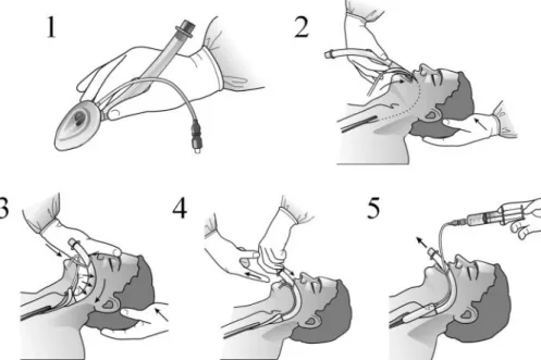 Figure 2. Manufacturer’s recommended insertion technique (Courtesy of LMA North America, San Diego, CA): (1) Deflate the laryngeal mask airway (LMA) cuff to a smooth low profile shape