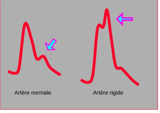 Figure  21.7 :  Comparaison  d’une  artère  normale  et  d’une  artère  rigidifiée  par  une  athéromatose  diffuse (artère fémorale)