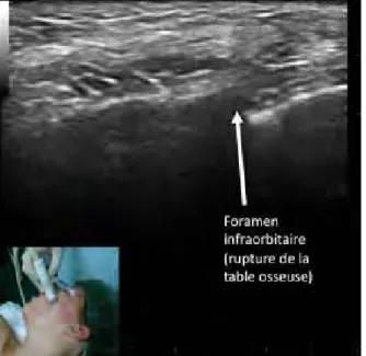 Figure 2  : Image échographique du foramen infra-orbitaire. (sonde en position  horizontale) On note très nettement la rupture de la table osseuse, témoin du  foramen.