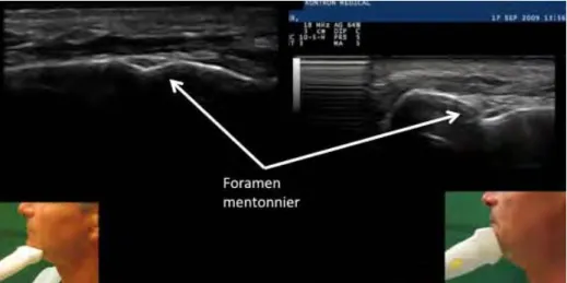 Figure 3 : Image échographique du foramen mental. On note parfaitement la 