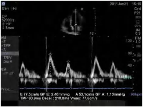 Figure 1 :  Flux Doppler Mitral Normal