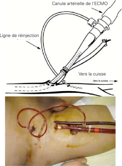 Figure 1 :  Canulation fémorale pour une assistance type ECMO.