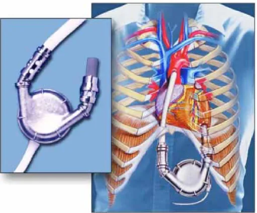 Figure 5 :  Assistance mono-ventriculaire gauche HeartMate-VETM testée dans  l’essai randomisé multicentrique REMATCH [33].