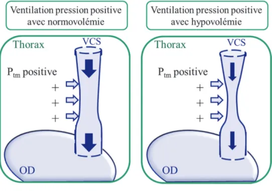 Figure 3.- Variations de la veine cave supérieure en normo et hypovolémie lors de la mise  sous ventilation en pression positive