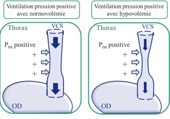 Figure 3.- Variations de la veine cave supérieure en normo et hypovolémie lors de la mise  sous ventilation en pression positive
