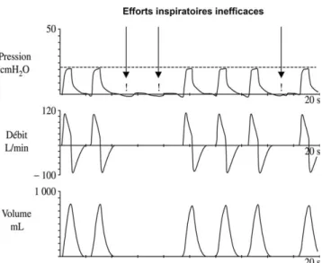 Fig. 1 . Représentation schématique d’efforts inspiratoires inefficaces en aide inspiratoire