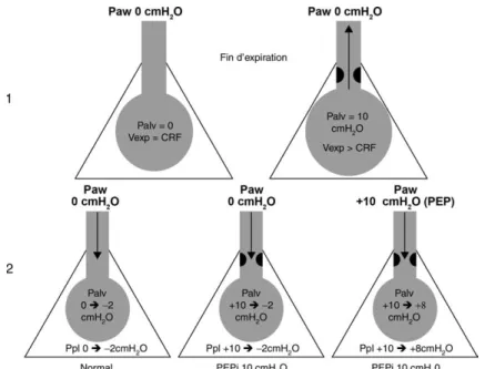 Fig. 2 . Physiopathologie des efforts inefficaces en aide inspiratoire :