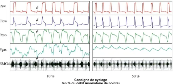 Fig. 4 . Exemple de désynchronisation sévère chez un patient BPCO intubé et ventilé en AI (à gauche)