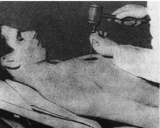 Figure 10 : Insertion au marteau d'une aiguille dans la cavité médullaire sternale. 