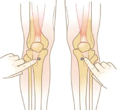 Figure 30 : Repérage de la tubérosité antérieure et insertion 2 cm  en dedans. 