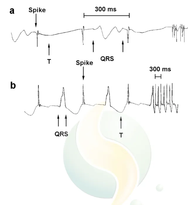 Figure 1.  Exemple de tracé ECG  obtenu chez le lapin.  Les traits fins ne sont pas les complexes  QRS, mais la trace du pacemaker chargé d'entrainer le cœur (noter en a) qu'il y a échappement à  cet  entraînement)