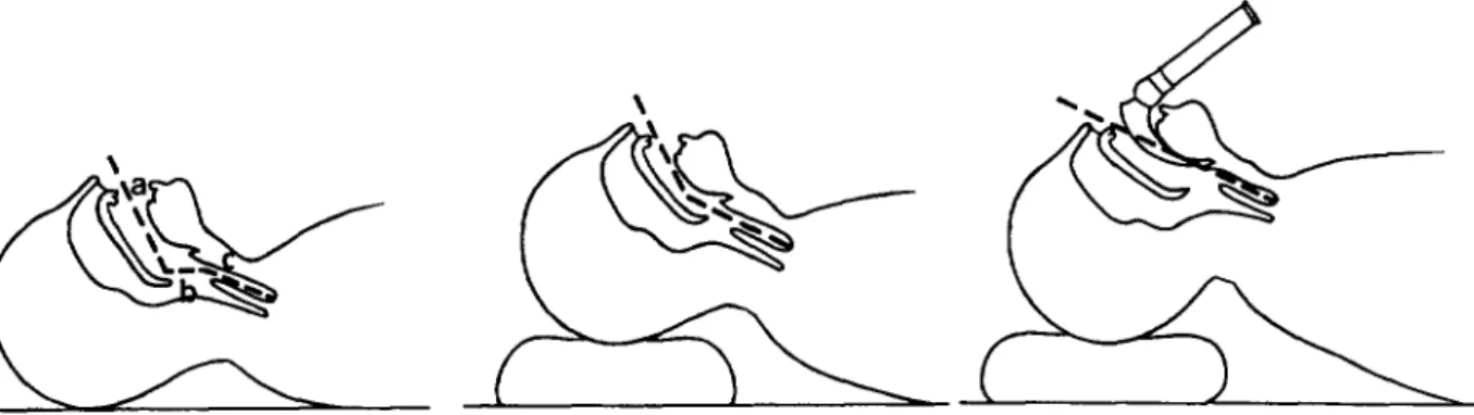fig  2).  La  ventilation  au masque  est  consid&amp;e  comme 