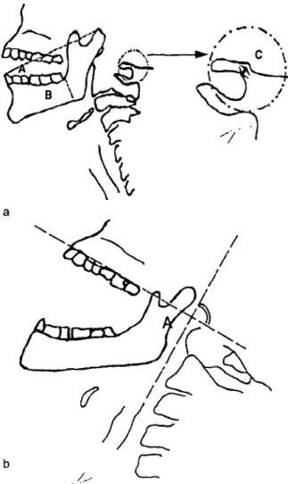 Fig  3.  a  : clichk  de  profil,  regard  B l’horizontale  selon  White  et  Kan-  der  ;  il  y  a  lieu  de  craindre  une  ID  soit  lorsque  A/B  <  3.6  ou  lorsque  C  <  4  mm  ;  b  : clichk  de  profil,  t&amp;te  en  position  d’intubation