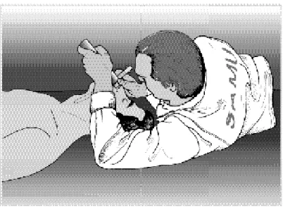 Figure 3. Intubation d'un patient gisant au sol en adoptant la position  décubitus latéral gauche pour l'opérateur