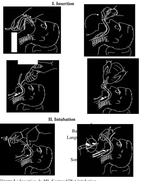 Figure 1 : Insertion du ML-Fastrach™et intubation