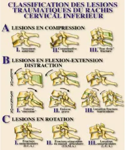 Figure 1  : Classification des lésions traumatiques du rachis cervical inférieur.  Maîtrise orthopédique 1997 (Argenson C, De Peretti F, Ghabris A, Eude P, Lovet  J, Hovorka I