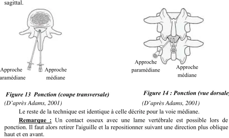 Figure 13  Ponction (coupe transversale)  (D’après Adams, 2001)  Approche    paramédianeApproche médiane Approche paramédiane Approche médiane 