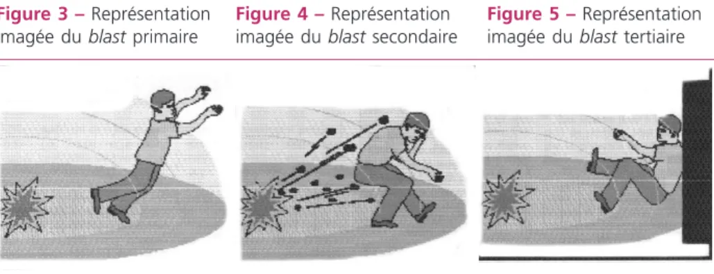 Figure 3 –  Représentation  imagée du blast primaire