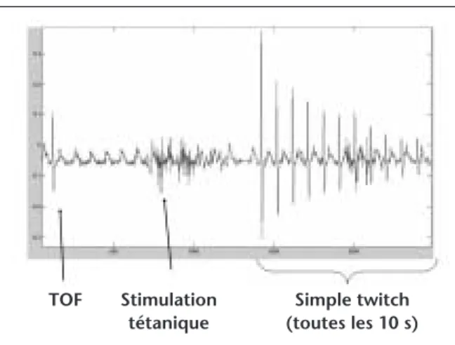 FIGURE 1 :  Les modes de stimulation les plus fréquents d’un muscle partiellement relâché