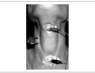 FIGURE 4 :  Monitorage postérieur du diaphragme par la PMG. Le microphone est fixé à l’aide d’un ruban adhésif
