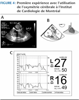 FIGURE 4 : Première expérience avec l’utilisation de l’oxymétrie cérébrale à l’Institut  de Cardiologie de Montréal