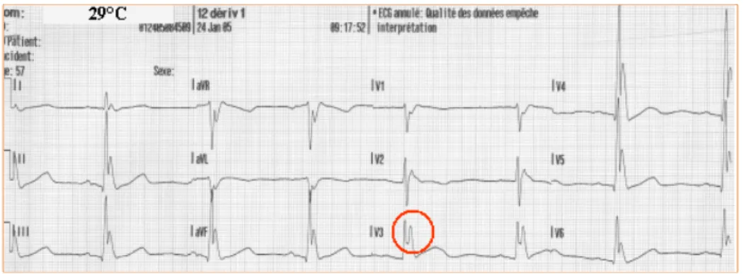 Figure 1 –  Onde J d’Osborn chez un patient ayant une température centrale de 29 °C