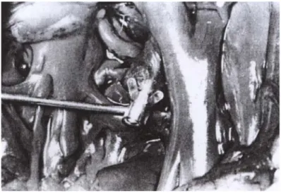 Figure 13 : Sonde à barbes en position  intracavitaire, d’après Kusumoto et  Goldschlager [53]