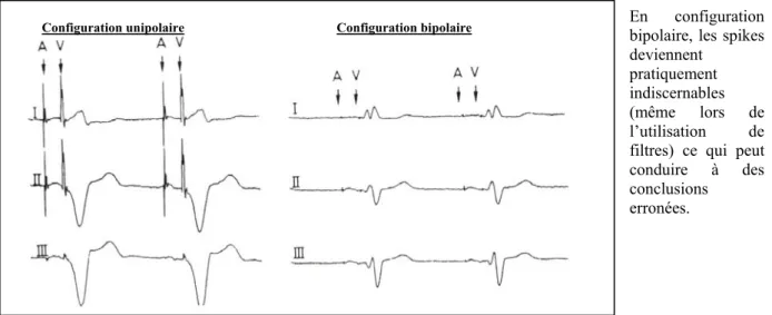 Figure 19 : Aspect des spikes de stimulation en mode unipolaire ou bipolaire, d’après Ritter et Fischer  [72]