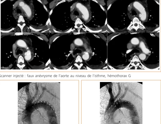 Figure 1 –  Rupture posttraumatique de l’isthme aortique traité par endoprothèse