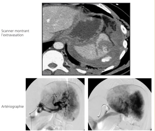 Figure 2 –  Traumatisme splénique : le scanner montre une fracture de la rate  et une extravasation active de produit de contraste exprimant un saignement actif