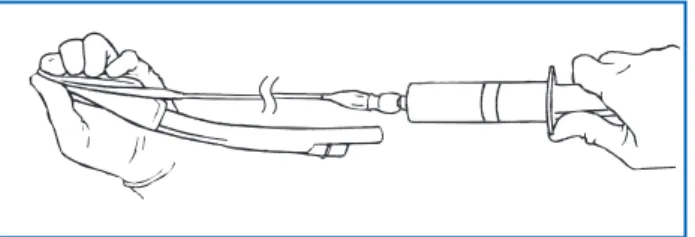 Figure 5 : LMA-ProSeal™  dégonflé à la main (remarquer la compression manuelle de la pointe).