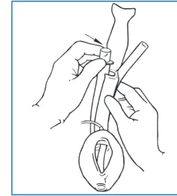 Figure 7a : Glisser la pointe de la poignée- poignée-guide dans la sangle du LMA-ProSeal™.