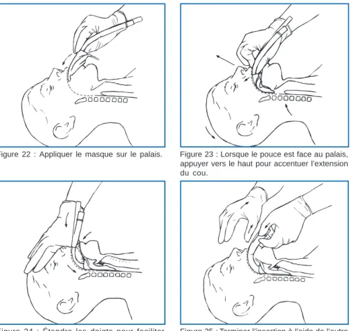 Figure 21 : Prise du LMA-ProSeal™, le pouce est glissé dans la sangle.