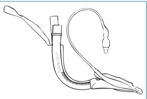 Figure 2. LMA-ProSeal™  avec guide en place.