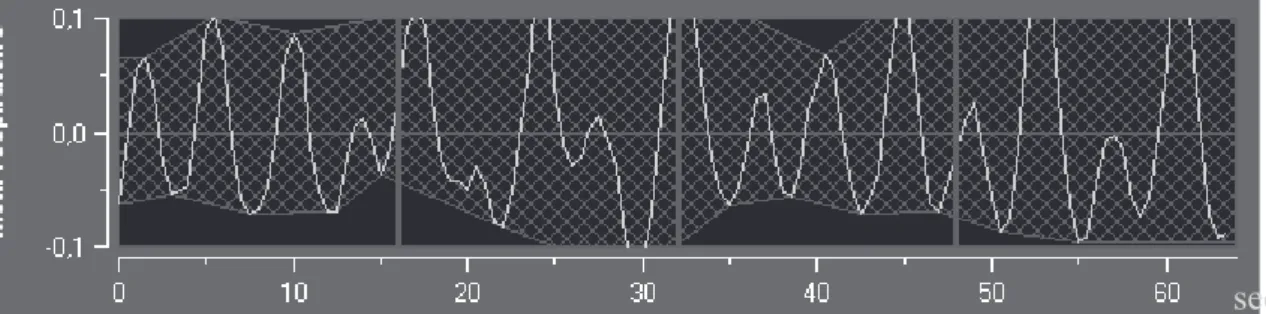 Figure 3.- Exemple de calcul de l’index ANI, basé sur le rapport de la surface des « motifs  respiratoires » de la variabilité de l’intervalle RR par rapport à sa valeur moyenne, chez un  patient anesthésié