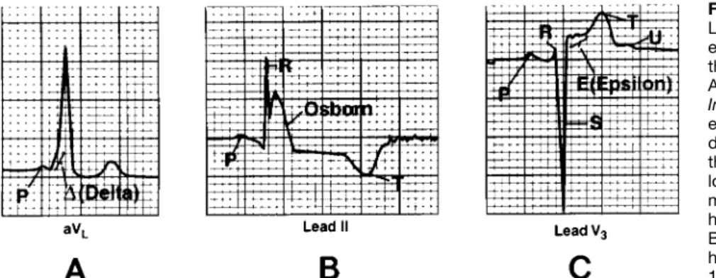 Figure 4. A, Delta wave, named by Segers, Lequime, and Denolin (see text and  Refer-ence 17)