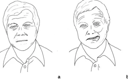 Figure 3.1 : Expression faciale (a) normale, (b) anormale