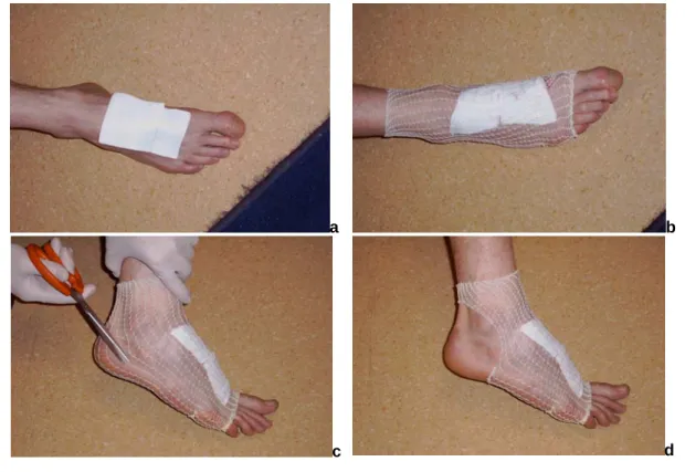Figure 7.21 : Filet tubulaire pour une plaie du pied