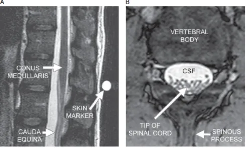 Fig. 10. D’après [72] - Ranger MRB, Irwin GJ, Bunbury KM, Peutrell JM. Changing body position alters the  location of the spinal cord within the vertebral canal: a magnetic resonance imaging study