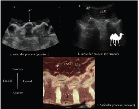 Fig. 13. D’après [74] - Karmakar MK, Li X, Kwok WH, Ho AM, Ngan Kee WD. Sonoanatomy relevant for  ultrasound-guided central neuraxial blocks via the paramedian approach in the lumbar region