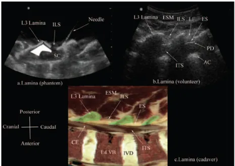 Fig. 15.- D’après [74] - Karmakar MK, Li X, Kwok WH, Ho AM, Ngan Kee WD. Sonoanatomy relevant for  ultrasound-guided central neuraxial blocks via the paramedian approach in the lumbar region