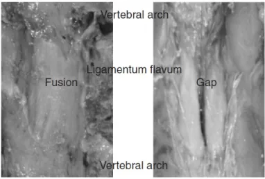Fig. 1.- Lirk P, Moriggl B, Colvin J, Keller C, Kirchmair L, Rieder J, Kolbitsch C. The incidence of lumbar  ligamentum flavum midline gaps