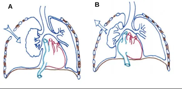Figure 4. Physiopathologie de la plaie soufflante thoracique lors de plaies thoraciques