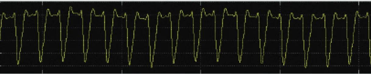 Figure 8. Limitations of PVI: Sample of photoplethysmogram with A) abnormally large dichrotic notches, B) abnormal shape, and C) corrupted by patient movement  – all of which can prevent the calculation of PI and the estimation of PVI.