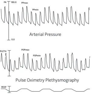 Figure 1. Relation between respiratory variations in pulse oximetry plethysmographic waveform amplitude and arterial pulse pressure in ventilated patients