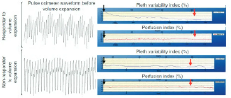 Figure 5. PVI and PI during volume expansion in fluid responder and non-responder. 19